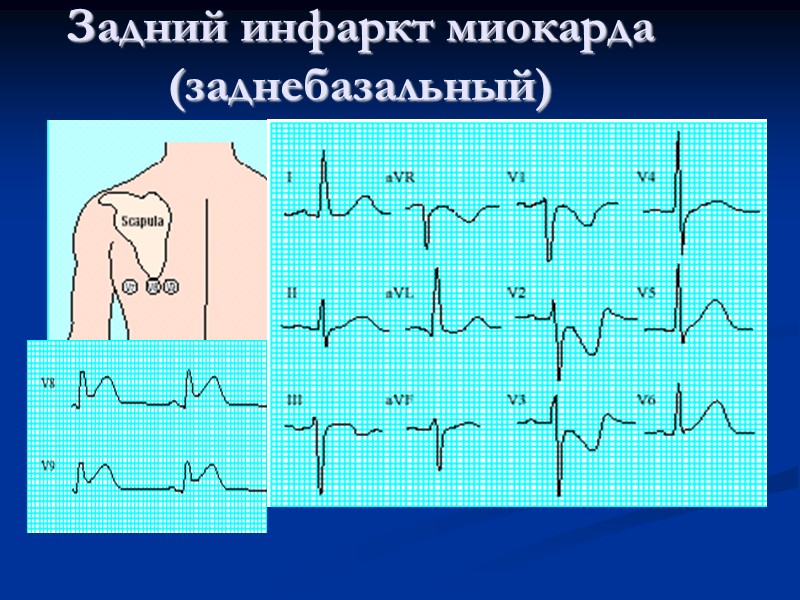 Задний инфаркт миокарда (заднебазальный)